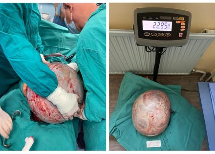 Ženi u Banjaluci izvađen tumor težak čak 23 kilograma