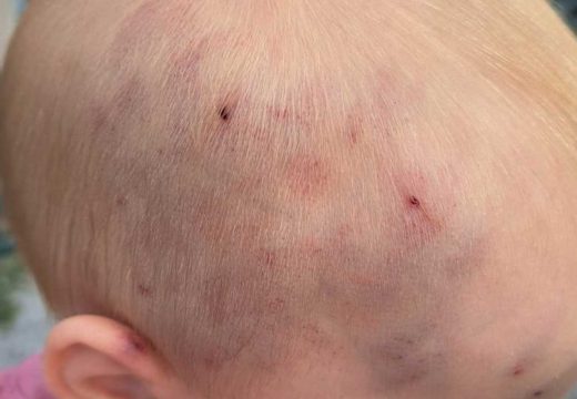 Šok u Slavonskom Brodu: Majka došla u jaslice, beba imala podlive i modrice