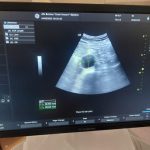 Veliko interesovanje građana za preventivne preglede: Na skriningu trbušne aorte pregledano 109 pacijenata, otkriveno šest aneurizmi