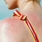 Savjeti iz Hemofarma: Znate li šta je solarna urtikarija?