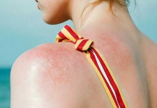 Savjeti iz Hemofarma: Znate li šta je solarna urtikarija?