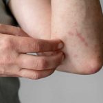 Hrvatska: Infektolog o slučaju gube, otkrila koliki je rizik od širenja zaraze