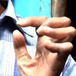 Zdravlje: Ima li rizika od širenja gube u Bosni i Hercegovini?